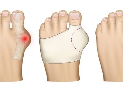 Hallux-valgus-Bandagen: weicher Daumenschutz, angenehmer Tragekomfort und weniger Druck in den Schuhen