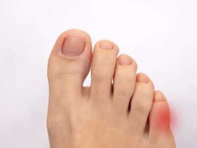 Zehenspreizer: Schutz für den kleinen Finger, Zehenspreizer und weiche Druckentlastungshilfen in Schuhen